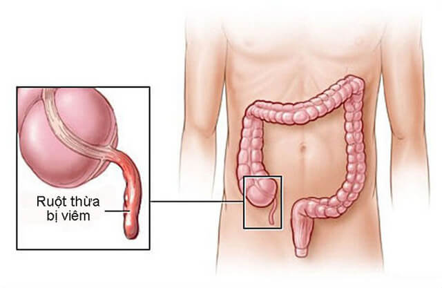 Viêm ruột thừa là nguyên nhân gây tắc vòi trứng